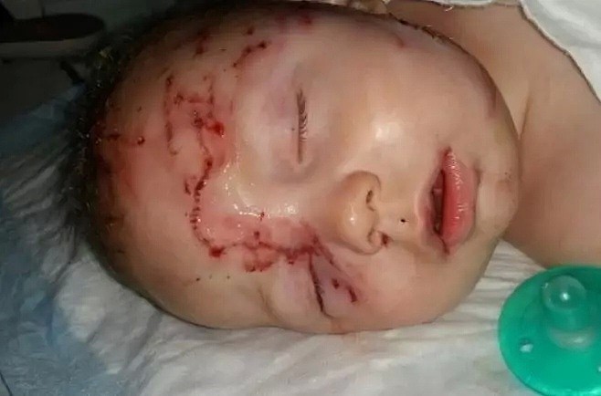 太可怕！7个月大婴儿遭自家宠物狗撕咬，温哥华医院抢救5小时，头部粉碎骨折（组图） - 5