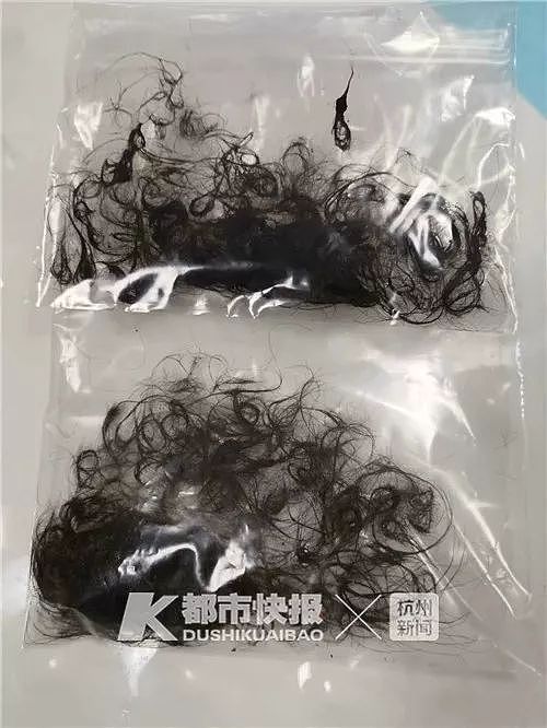 16个小时“拉丝”手术，用坏6把异物钳！心疼，3岁女孩胃里取出两袋头发（组图） - 4