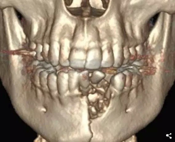 “牙龈炸出大洞”电子烟爆炸 17岁男孩下巴碎裂（组图） - 2