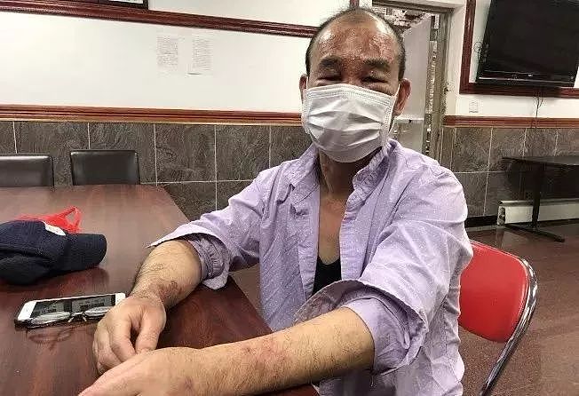 中餐馆化学物爆炸，华男全脸被腐蚀，当心这样做无法获得赔偿（组图） - 1