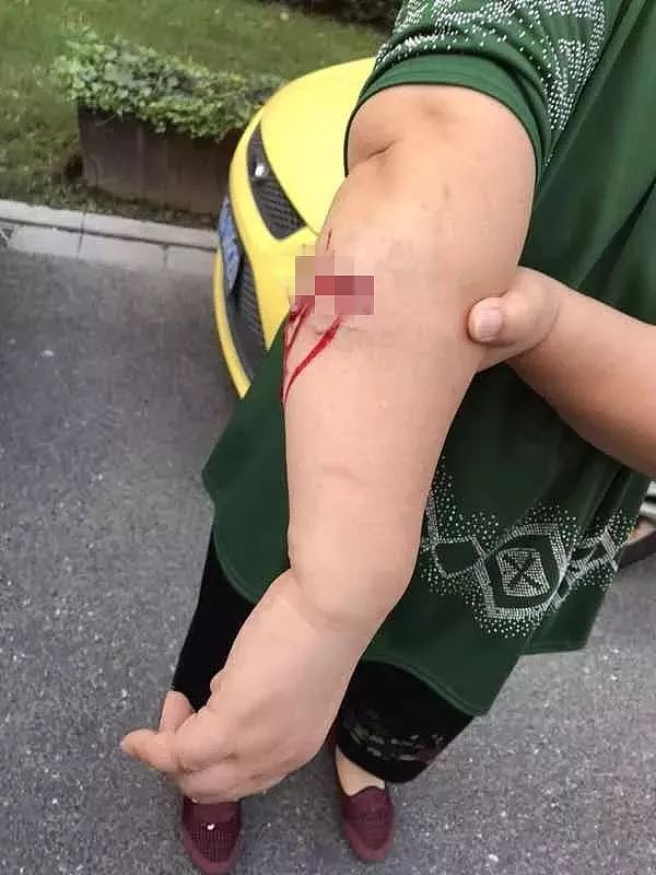 日本人遭中国大型犬撕咬 受伤女：不是狗的问题（视频/组图） - 32