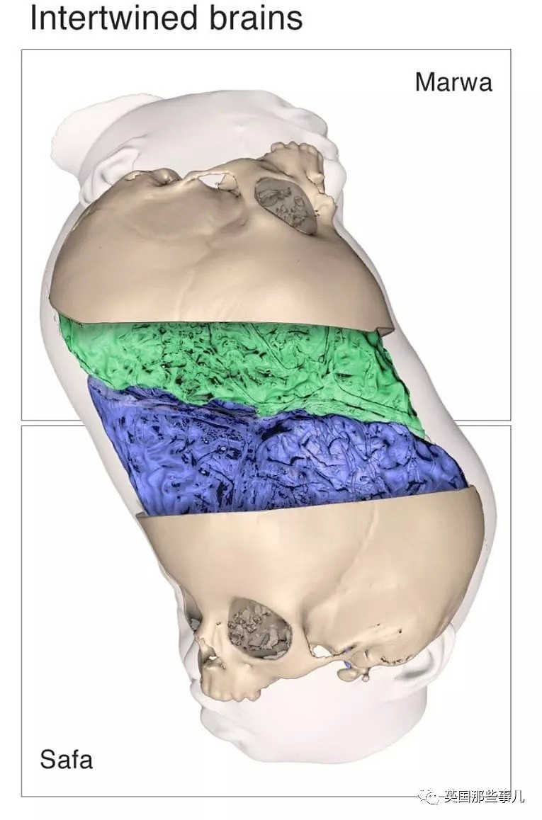 他们把头部相连大脑互缠的女婴成功分离！金钱+技术+运气…这一路太不容易！（组图） - 9