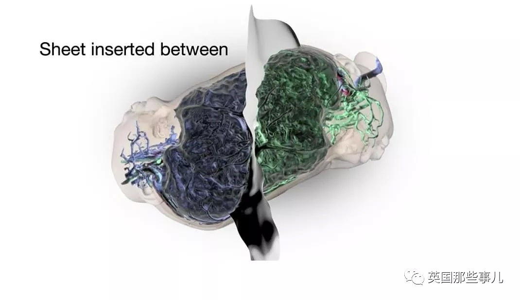 他们把头部相连大脑互缠的女婴成功分离！金钱+技术+运气…这一路太不容易！（组图） - 16