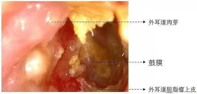 “耳屎”太多被同事吐槽！杭州漂亮姑娘去医院一查，吓得直掉眼泪！（组图） - 3