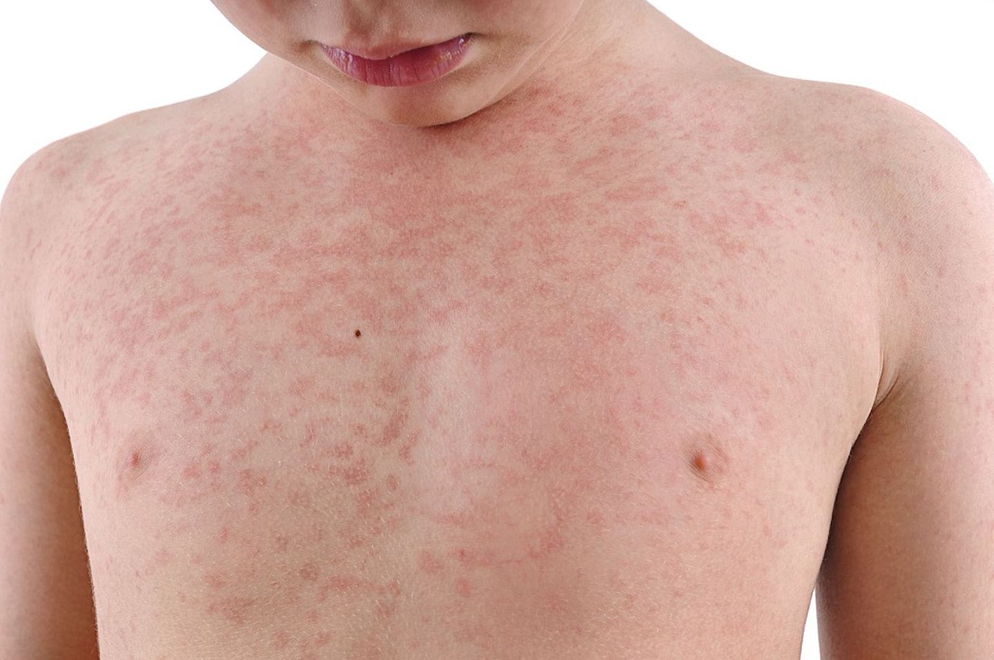 澳洲男子带回绝种传染病，打喷嚏、咳嗽均可传染！当局呼吁及时接种疫苗（组图） - 4