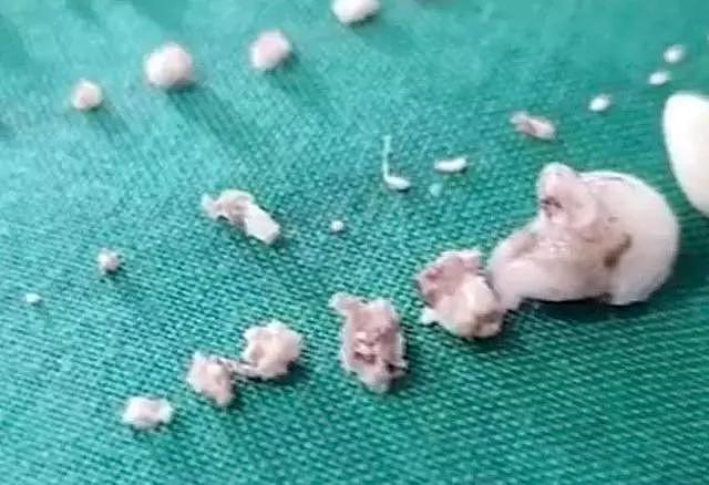 男子下颌肿胀被送医，医生取出526颗牙齿，看着像珍珠