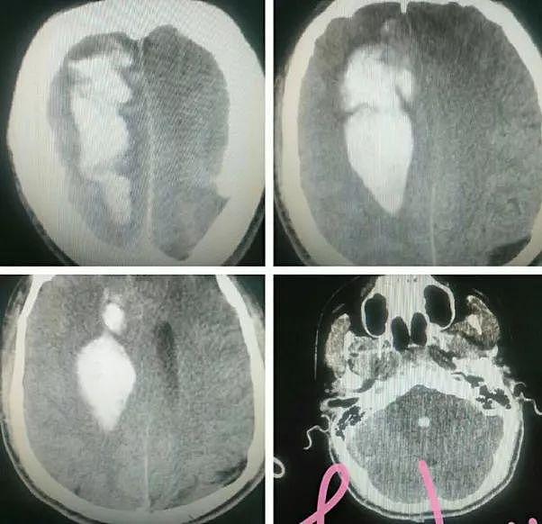 杭州16岁高中生突然头痛欲裂陷昏迷，医生开颅发现，...
