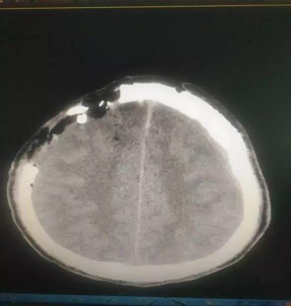 杭州16岁高中生突然头痛欲裂陷昏迷，医生开颅发现，...