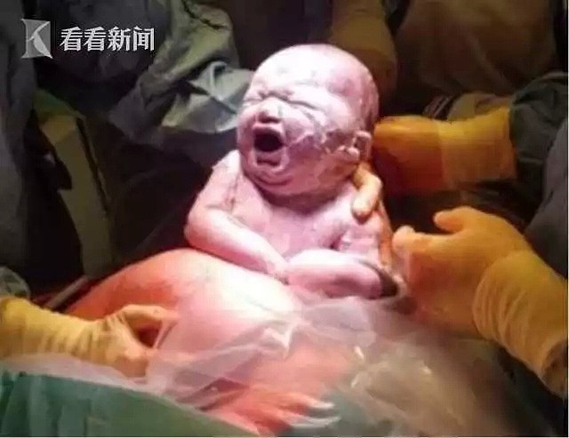 女子剖腹产子，男婴刚取出似外星人！医生：天呐…（组图） - 2