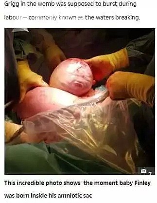 女子剖腹产子，男婴刚取出似外星人！医生：天呐…（组图） - 3