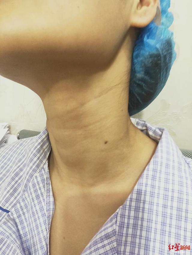 28岁女护士命丧整形手术台 丈夫：整个脖子都是密密麻麻的针眼