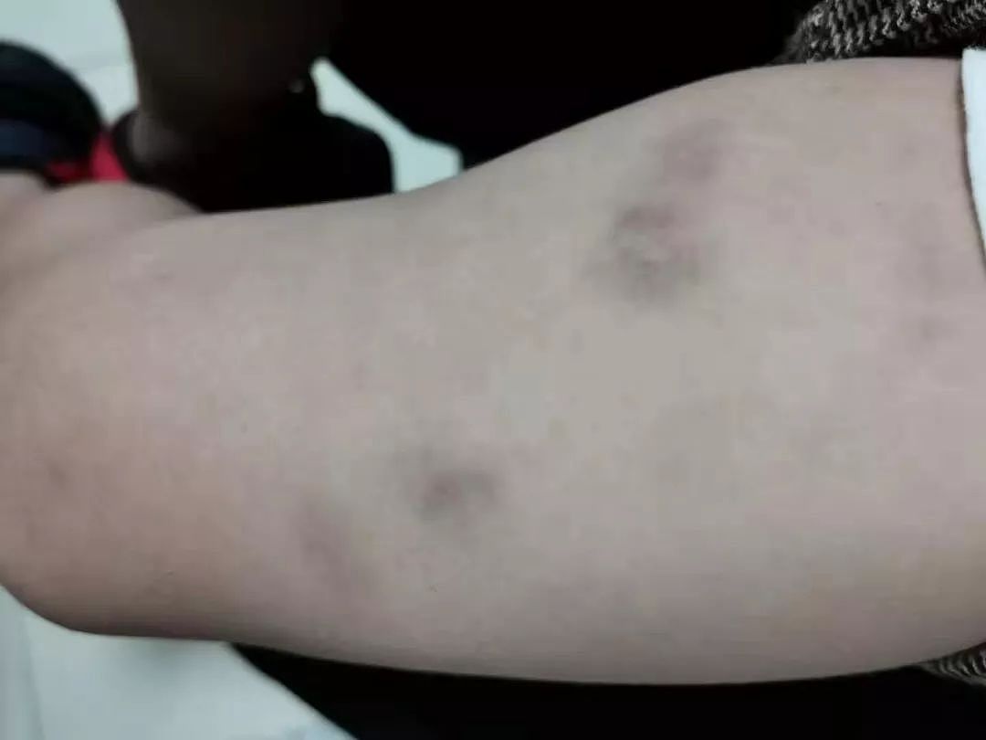 网友怒诉：2岁娃在新加坡幼儿园被惨虐，大腿内侧淤青10来天未退！（组图） - 1