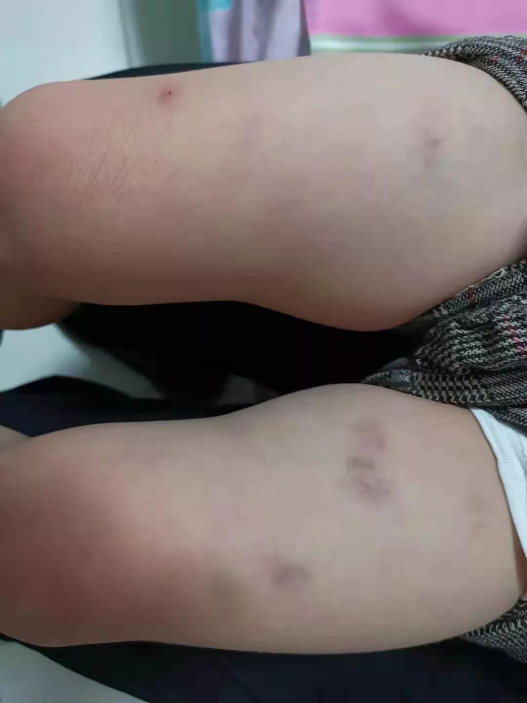 网友怒诉：2岁娃在新加坡幼儿园被惨虐，大腿内侧淤青10来天未退！（组图） - 3