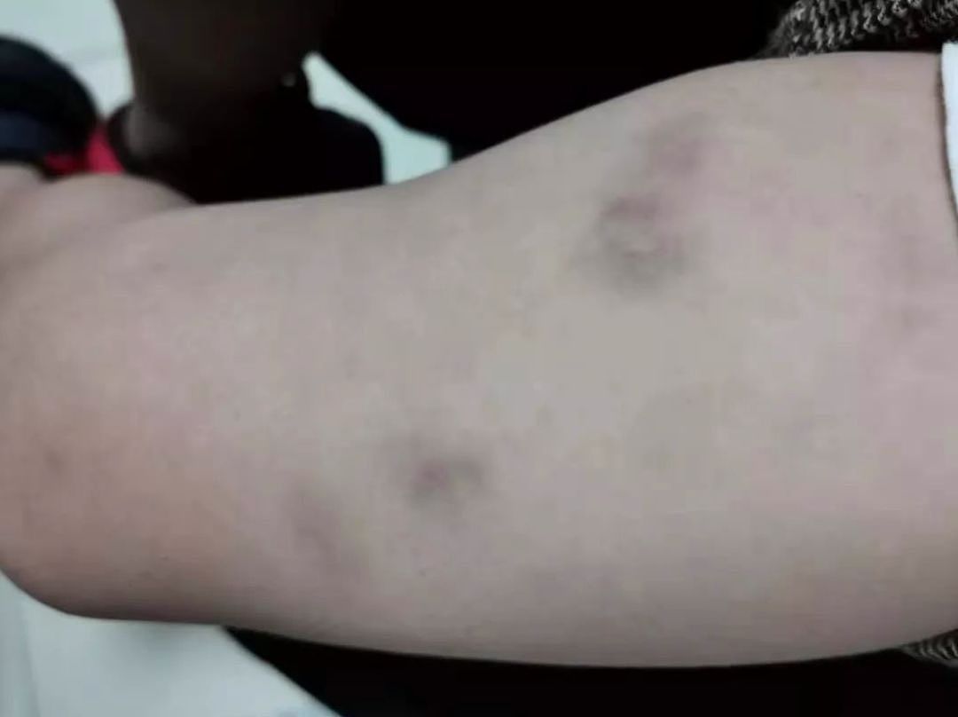 网友怒诉：2岁娃在新加坡幼儿园被惨虐，大腿内侧淤青10来天未退！（组图） - 4