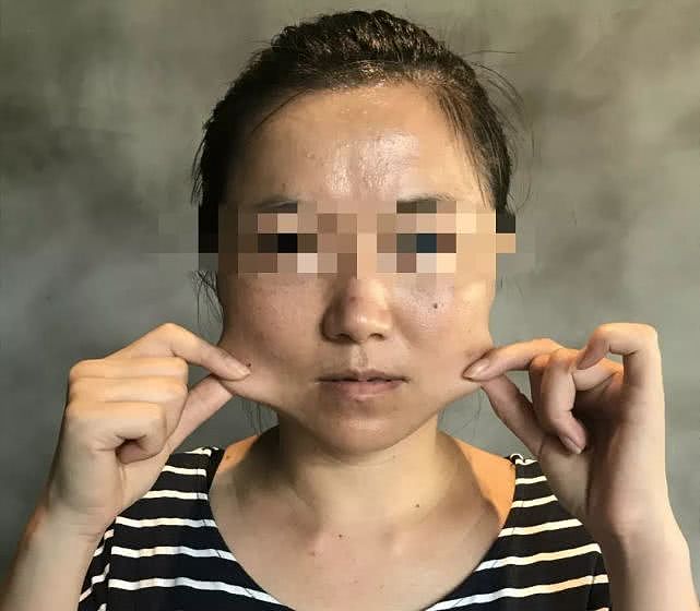 打瘦脸针之后，李帆的脸变得松弛。受访者供图，摄于2019年8月。受访者供图。