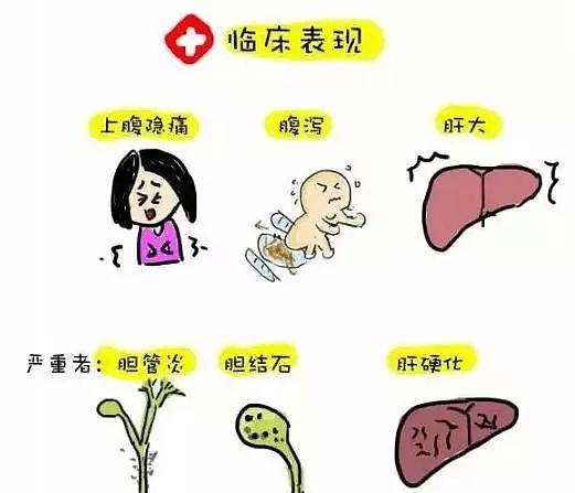 恐怖！华人男子吃了顿生鱼片，肝脏被活虫爬满 差点终生残疾...（组图） - 7