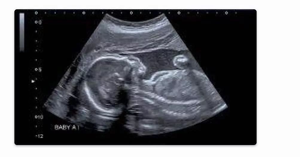 恐怖！堕胎医生家中发现2200具胎儿尸体（图） - 2