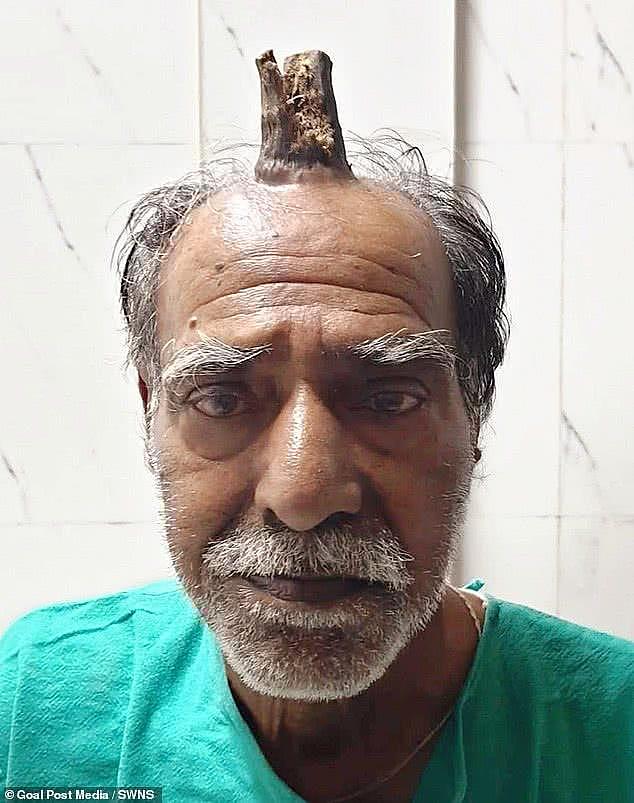 印度74岁男子头上长出10厘米“魔鬼之角”，真实版“小龙人”