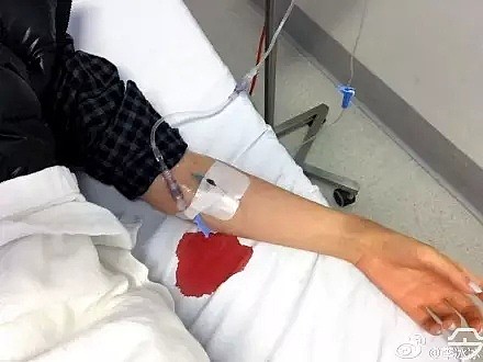 澳少女在中国受伤选择回澳治疗，不幸遭遇医疗失误！被迫截肢，拇指变脚趾！网友疯狂吐槽澳公立医院... - 2