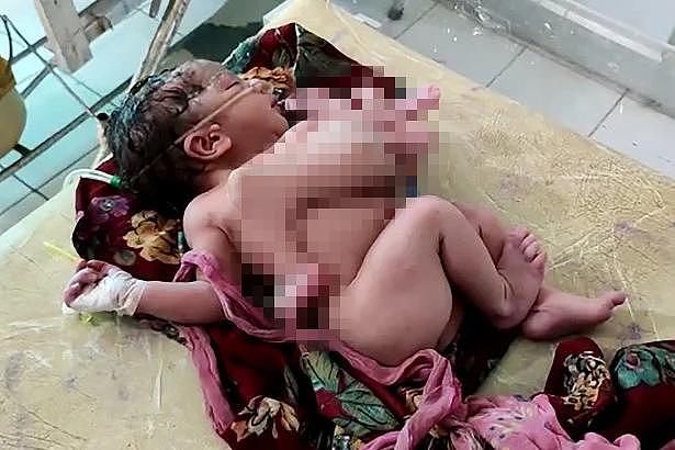 印女子怀孕从未做检查产下三胞胎，两名女婴成连体有4条脚3只手