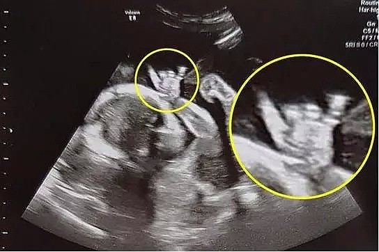 孕妇做B超被吓懵，腹中孩子突然睁眼怪笑！医生说这宝宝留不得…（组图） - 4