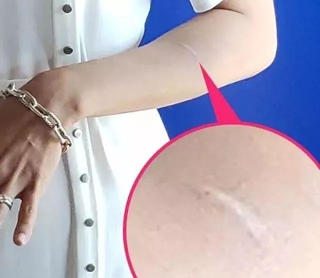 自曝被家暴！35岁钟嘉欣左手伤疤明显 本拿比华裔精英丈夫这样对她（组图） - 2