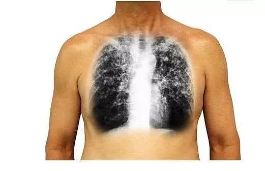 一旦“这几处”开始疼，十有八九是肺癌，三类人最好去检查一下！（组图） - 8