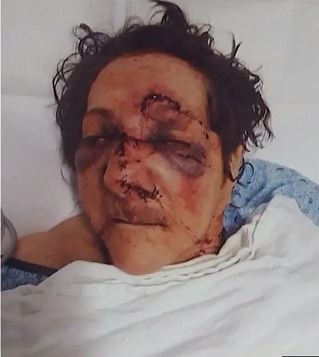 86岁母亲在养老院被虐待至面部骨折，养老院坚称是老人自己摔倒