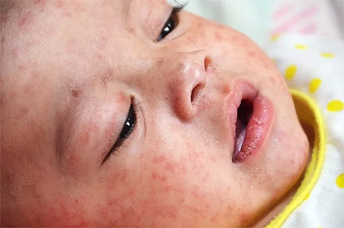 悲剧！2名奥克兰宝宝胎死腹中，竟是母亲感染了麻疹（组图） - 6