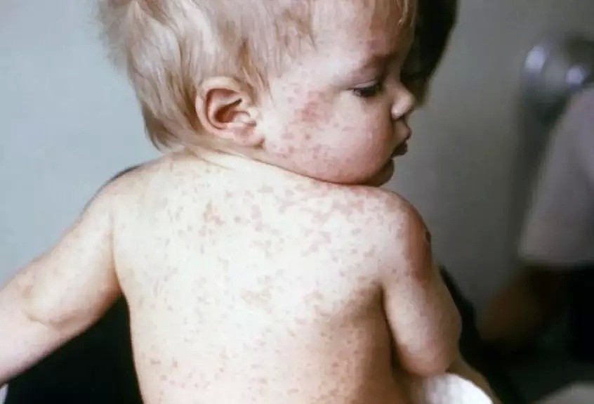 悲剧！2名奥克兰宝宝胎死腹中，竟是母亲感染了麻疹（组图） - 7