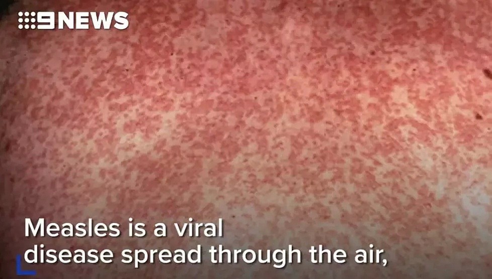 致命麻疹病毒出现在布里斯班机场，去过这些地方的人请自查！ - 4