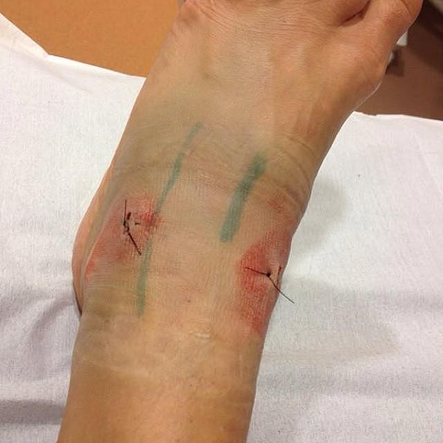 丘索维金娜接受脚部手术治疗
