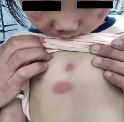 6岁女孩脸上布满脓疱红斑，元凶竟是孩子们爱不释手的这个（组图） - 1