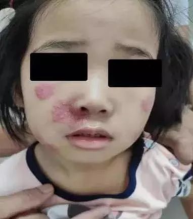 6岁女孩脸上布满脓疱红斑，元凶竟是孩子们爱不释手的这个（组图） - 4