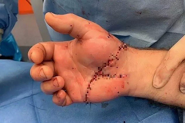 十年难遇的成功：澳男子手掌被切肉机斩断，外科医生奋战8小时创奇迹 - 8