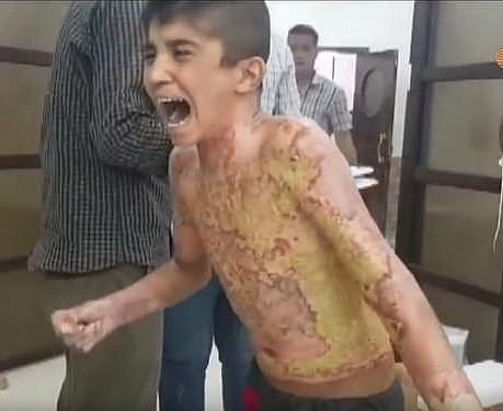 停火120小时前最惨景象！叙利亚5岁童遭化学武器攻击，全身皮如碎瓦墙...（组图） - 1