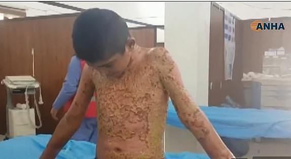 停火120小时前最惨景象！叙利亚5岁童遭化学武器攻击，全身皮如碎瓦墙...（组图） - 3