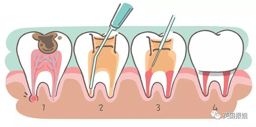 英国大哥因牙痛自杀？外国拔个智齿咋就这么难！（组图） - 12
