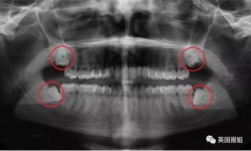 英国大哥因牙痛自杀 外国拔个智齿咋就这么难（组图） - 2