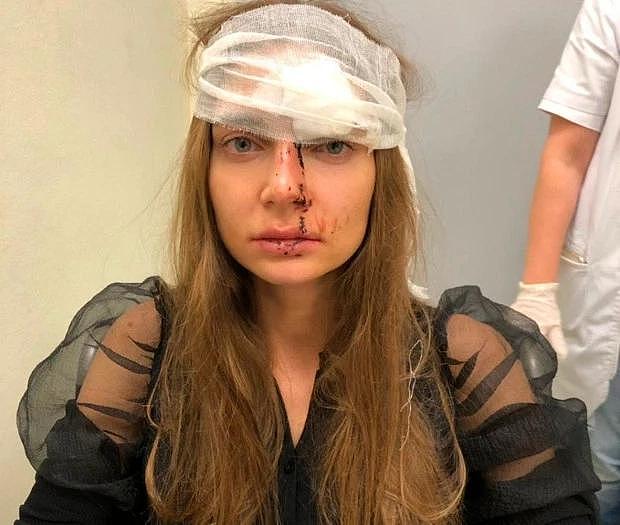 俄罗斯美女整形途中与医生发生冲突，遭医生用手机暴打，血流满面