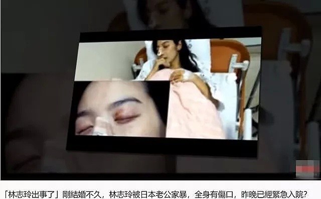 女神志玲姐姐被家暴了？膝盖淤青，鼻子打肿，疑似住院…（组图） - 4