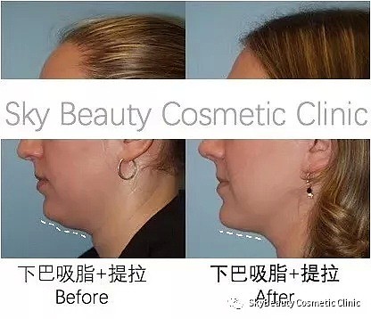 【Sky Beauty】悉尼医疗美容诊所，双11提前庆祝！超皮秒美白换肤+水感透白facial 只要68！ - 13