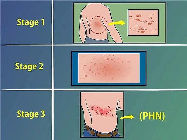 有一种剧痛叫做“带状疱疹”，7类人尤其要当心