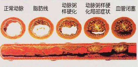 6台心梗手术，5个都不到40岁，他们都有一个共同爱好