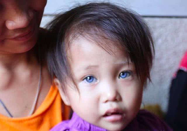  印尼小女孩患罕见病眼球天生能变4种颜色！医生：是遗传但无害（组图） - 3