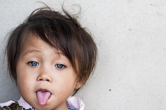  印尼小女孩患罕见病眼球天生能变4种颜色！医生：是遗传但无害（组图） - 5