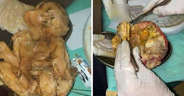 苏丹女子腹痛难忍上医院检查，照片才知腹中藏有一具15年婴儿尸体
