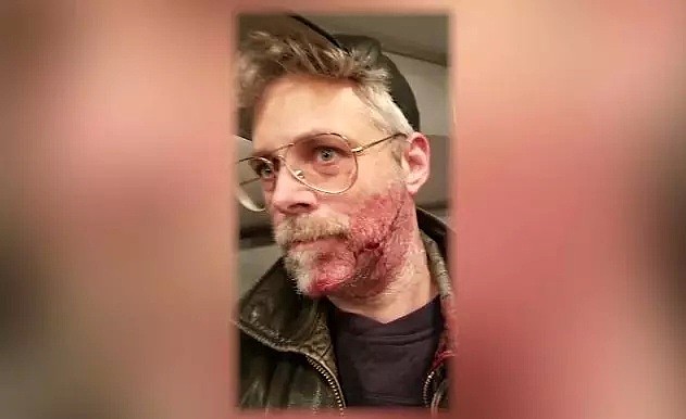 视频多图!纽约地铁曝割脸案!男子缝15针!满脸是血……（组图） - 6