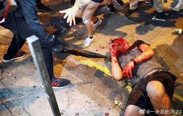 大陆游客在香港被残忍私刑 本人发声：“从地狱爬回的一天”（组图） - 6