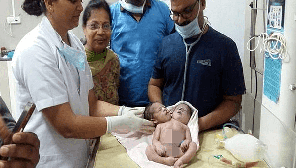 印度一新生儿有两头三臂四手掌（镜报）